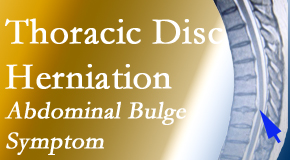 Cox Chiropractic Medicine Inc treats thoracic disc herniation that for some patients prompts abdominal pain.
