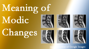 Cox Chiropractic Medicine Inc sees many back pain and neck pain patients who bring their MRIs with them to the office. Modic changes are often seen. 