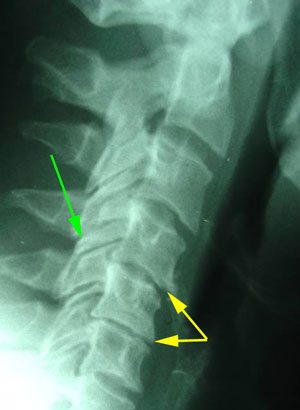 disc degeneration treated at Cox Chiropractic Medicine Inc