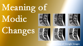 Cox Chiropractic Medicine Inc sees many back pain and neck pain patients who bring their MRIs with them to the office. Modic changes are often seen.
