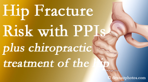 Cox Chiropractic Medicine Inc shares new research describing higher risk of hip fracture with proton pump inhibitor use. 