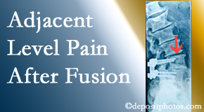 Cox Chiropractic Medicine Inc offers relieving care non-surgically to back pain patients suffering with adjacent level pain after spinal fusion surgery.