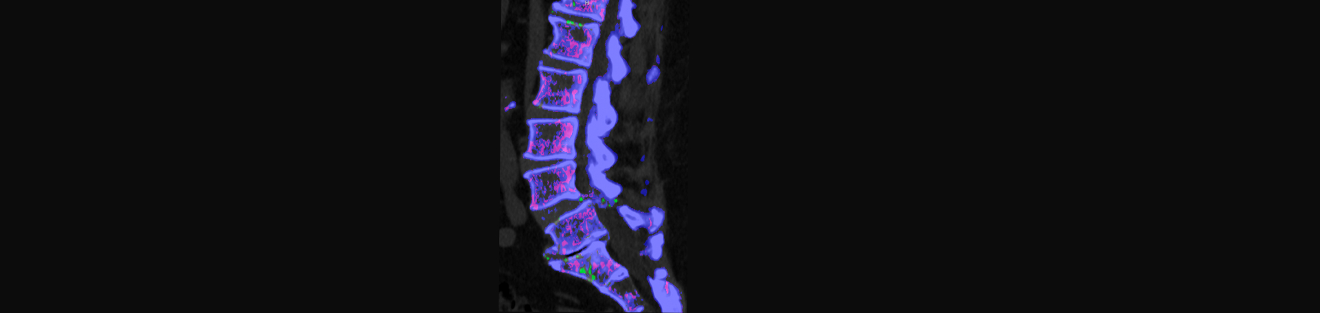 Cox Chiropractic Medicine Inc is aware that inflammatory spinal gout is a differential diagnosis to consider for patients who present with back pain and other spine related symptoms.