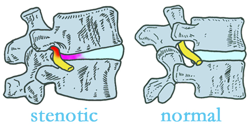 Fort Wayne stenotic and normal spinal discs