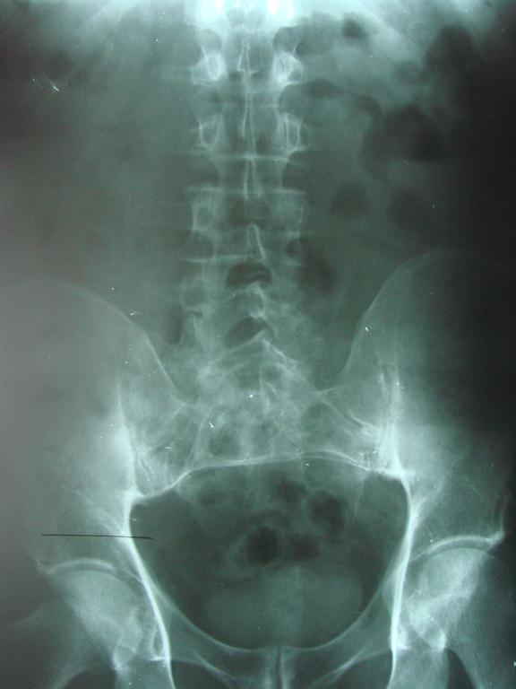 chiropractic Evaluation of Short Leg | Cox Chiropractic Medicine Inc